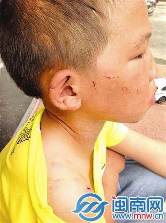 男孩的耳朵、脖子、臉上，有很多明顯的傷痕