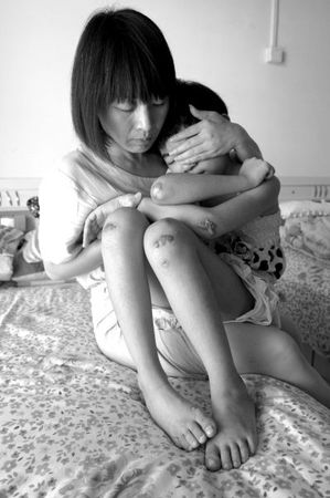 　女童的外傷基本痊愈，但留下了明顯的疤痕。京華時(shí)報(bào)記者蒲東峰攝