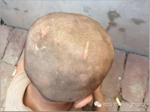 洪波的腦袋上，滿是母親毆打留下的傷痕。
