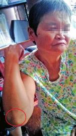 老人稱摔倒后其肘部、腿部多處擦傷