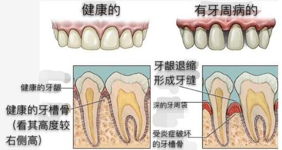 慎用牙簽？牙縫真的越剔越大嗎