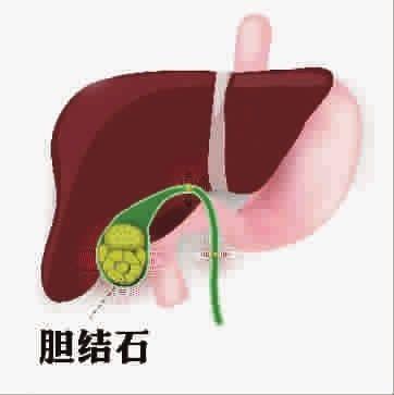 如何護(hù)理膽結(jié)石？高危人群要注意
