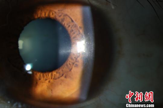 術(shù)后2年，患者角膜透明。供圖