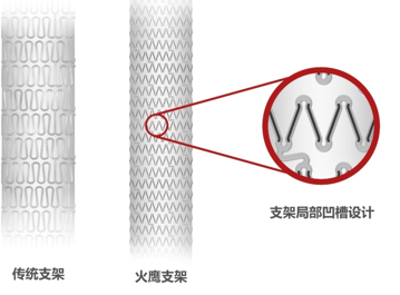 第二代傳統(tǒng)藥物洗脫支架與“火鷹支架”的結(jié)構(gòu)設計對比