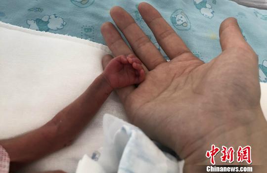 圖為寶寶的小手。(院方供圖) 張婭子 攝